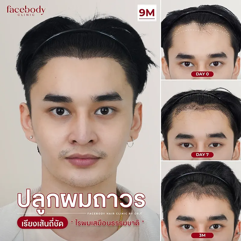 ปลูกผม ความประทับใจ ของลูกค้า