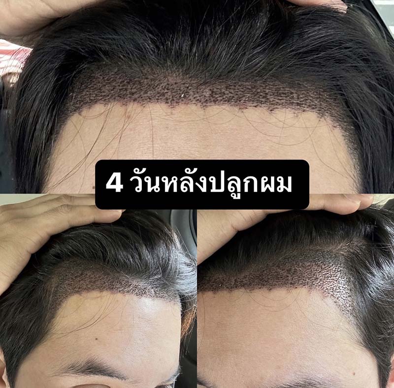 รีวิวปลูกผม 14 วัน คุณโอ๊ต Facebody Clinic วันที่ 4