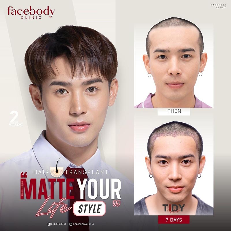 ปลูกผมผู้ชาย