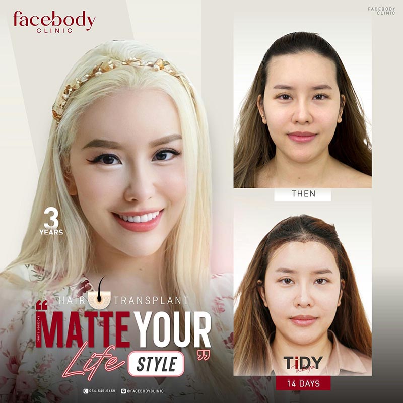 ปลูกผมผู้หญิง 2