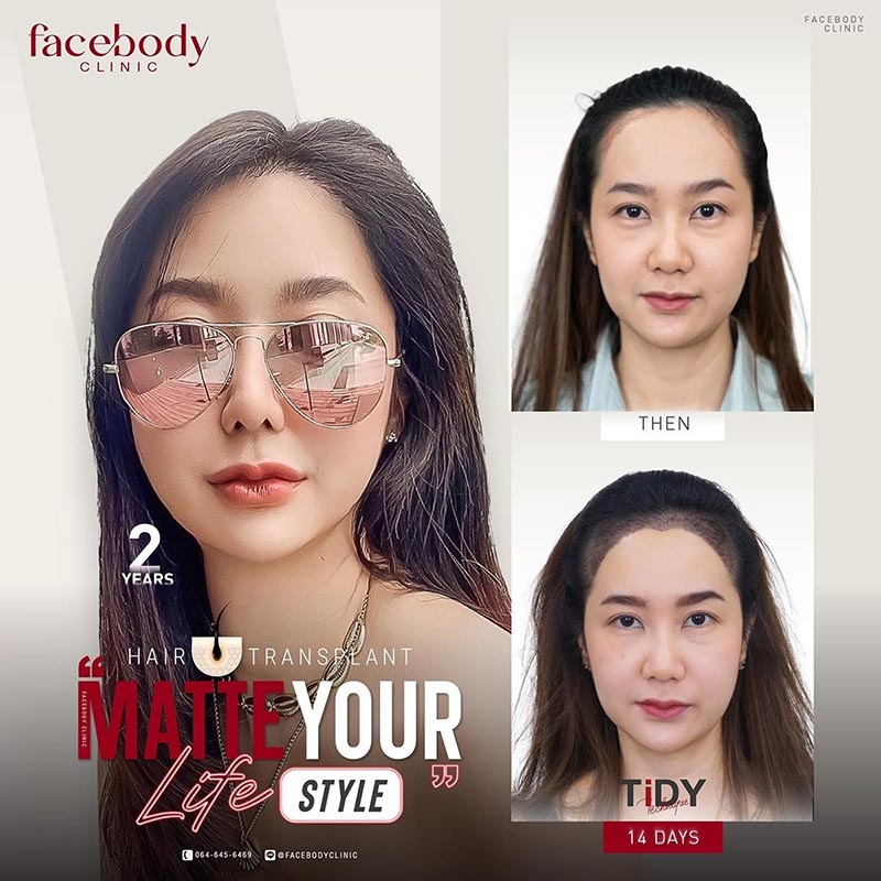 ปลูกผมผู้หญิง