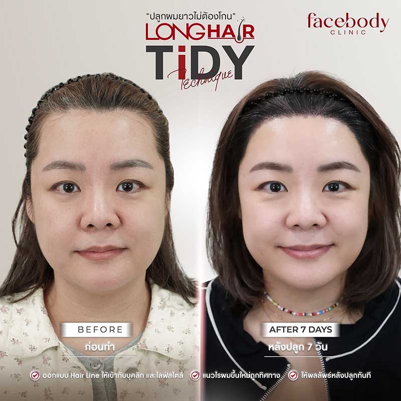 รีวิวปลูกผม Longhair ไม่ต้องโกน ผมยาวทันที เห็นผลจริงหลังทำ
