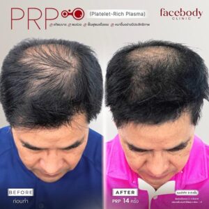 PRP STEMCELL ผม 2