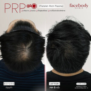 PRP STEMCELL ผม