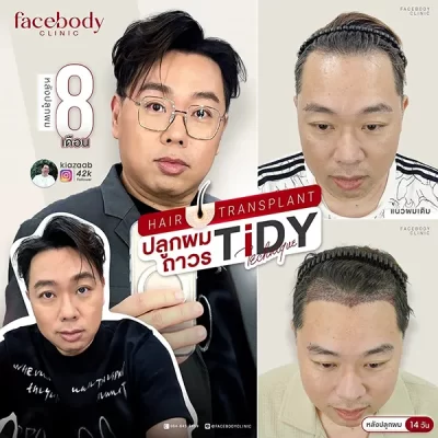 ปลูกผมถาวร เทคนิค Tidy