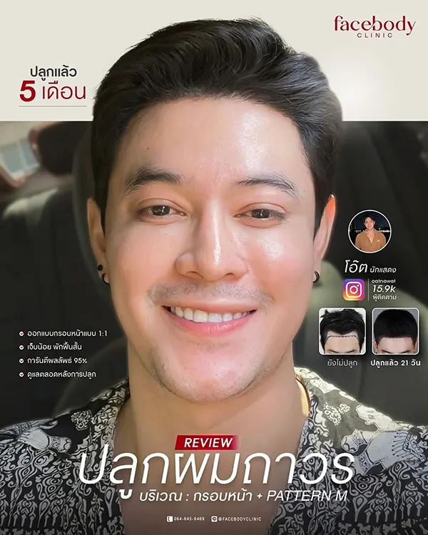 ปลูกผม อยู่ได้นานไหม? ไขทุกข้อสงสัยก่อนตัดสินใจปลูกผมถาวร