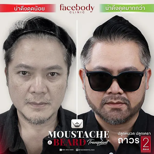 ปลูกคิ้ว เครา หนวด