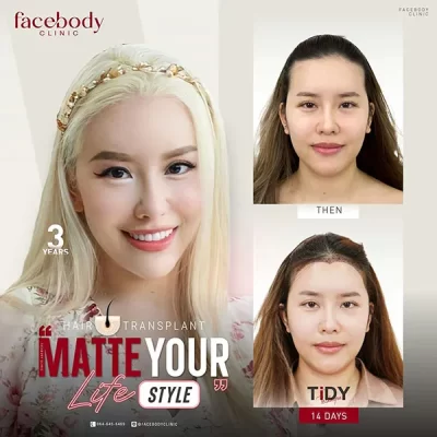 ปลูกผมผู้หญิง 2