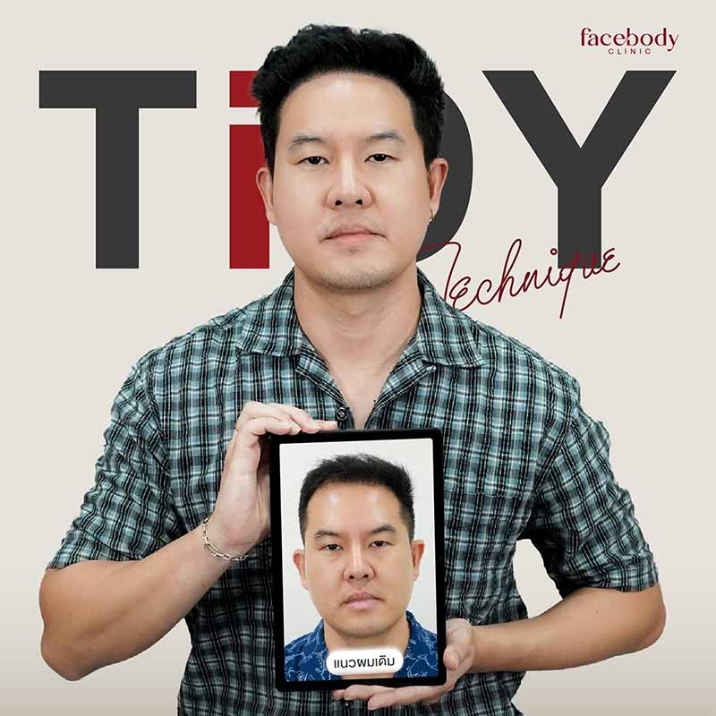 ไทม์ไลน์ หลังปลูกผม 6 เดือน : รู้ให้ชัดก่อนตัดสินใจปลูกผม