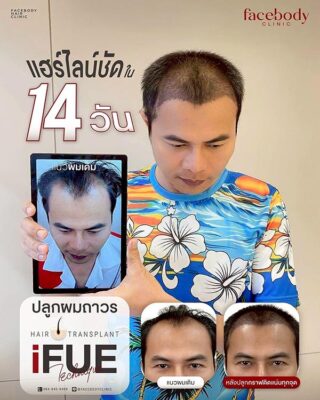 ผลลัพธ์หลังปลูก ยืนหน้า BACKDROP SET1 1