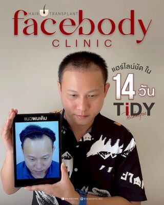 ผลลัพธ์หลังปลูก ยืนหน้า BACKDROP SET1 2