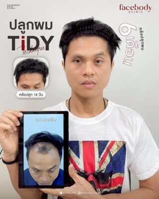 ผลลัพธ์หลังปลูก ยืนหน้า BACKDROP SET1 3