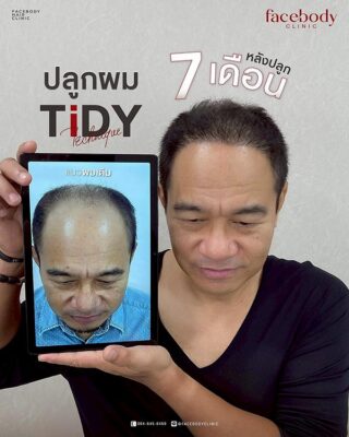 ผลลัพธ์หลังปลูก ยืนหน้า BACKDROP SET1 4