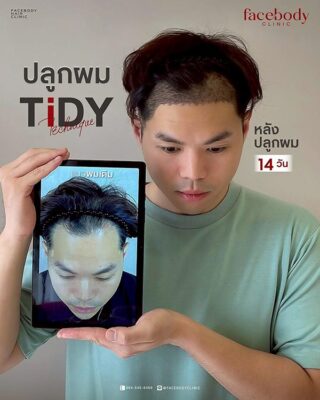 ผลลัพธ์หลังปลูก ยืนหน้า BACKDROP SET1 5