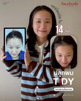 ผลลัพธ์หลังปลูก ยืนหน้า BACKDROP SET1 6