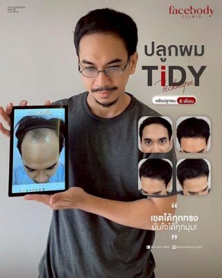 ผลลัพธ์หลังปลูก ยืนหน้า BACKDROP SET1 7