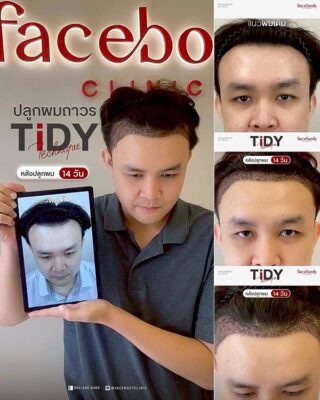 ผลลัพธ์หลังปลูกยืนหน้า BACKDROP FACEBODY SET 3 2