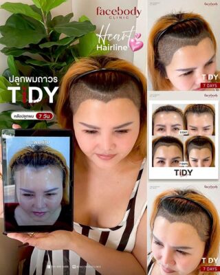 ผลลัพธ์หลังปลูกยืนหน้า BACKDROP FACEBODY SET 3 3