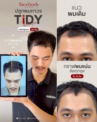 ผลลัพหลังปลูก ยืนหน้า BACKDROP FACEBODY SET 2 1