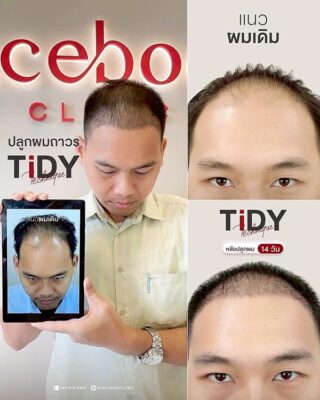 ผลลัพหลังปลูก ยืนหน้า BACKDROP FACEBODY SET 2 10