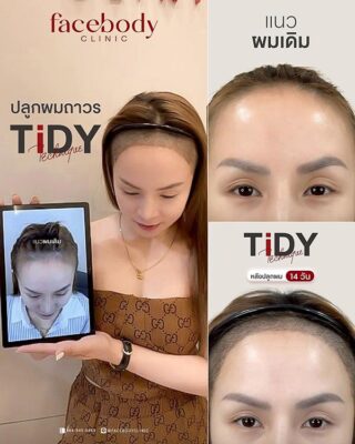 ผลลัพหลังปลูก ยืนหน้า BACKDROP FACEBODY SET 2 11