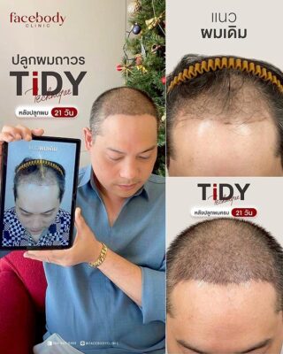 ผลลัพหลังปลูก ยืนหน้า BACKDROP FACEBODY SET 2 12