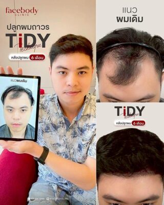 ผลลัพหลังปลูก ยืนหน้า BACKDROP FACEBODY SET 2 13