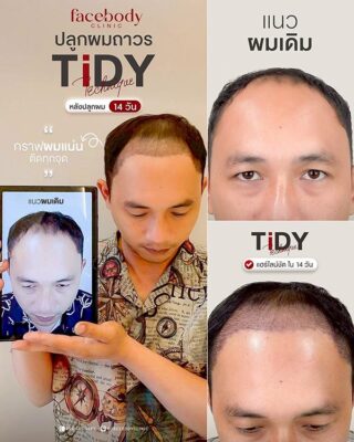 ผลลัพหลังปลูก ยืนหน้า BACKDROP FACEBODY SET 2 2