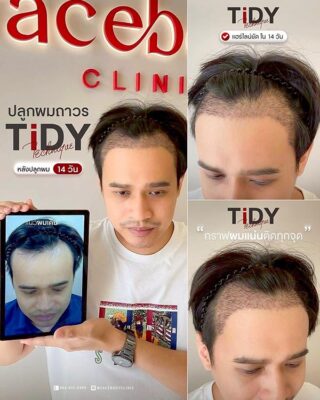 ผลลัพหลังปลูก ยืนหน้า BACKDROP FACEBODY SET 2 3