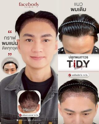 ผลลัพหลังปลูก ยืนหน้า BACKDROP FACEBODY SET 2 4