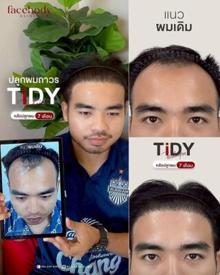 ผลลัพหลังปลูก ยืนหน้า BACKDROP FACEBODY SET 2 5