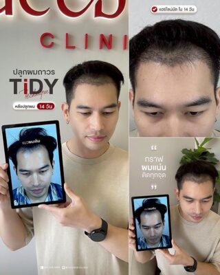 ผลลัพหลังปลูก ยืนหน้า BACKDROP FACEBODY SET 2 6