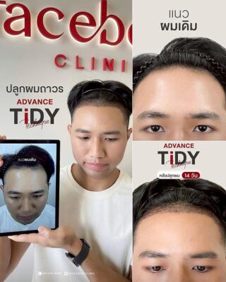 ผลลัพหลังปลูก ยืนหน้า BACKDROP FACEBODY SET 2 7
