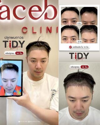 ผลลัพหลังปลูก ยืนหน้า BACKDROP FACEBODY SET 2 8