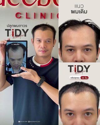 ผลลัพหลังปลูก ยืนหน้า BACKDROP FACEBODY SET 2 9