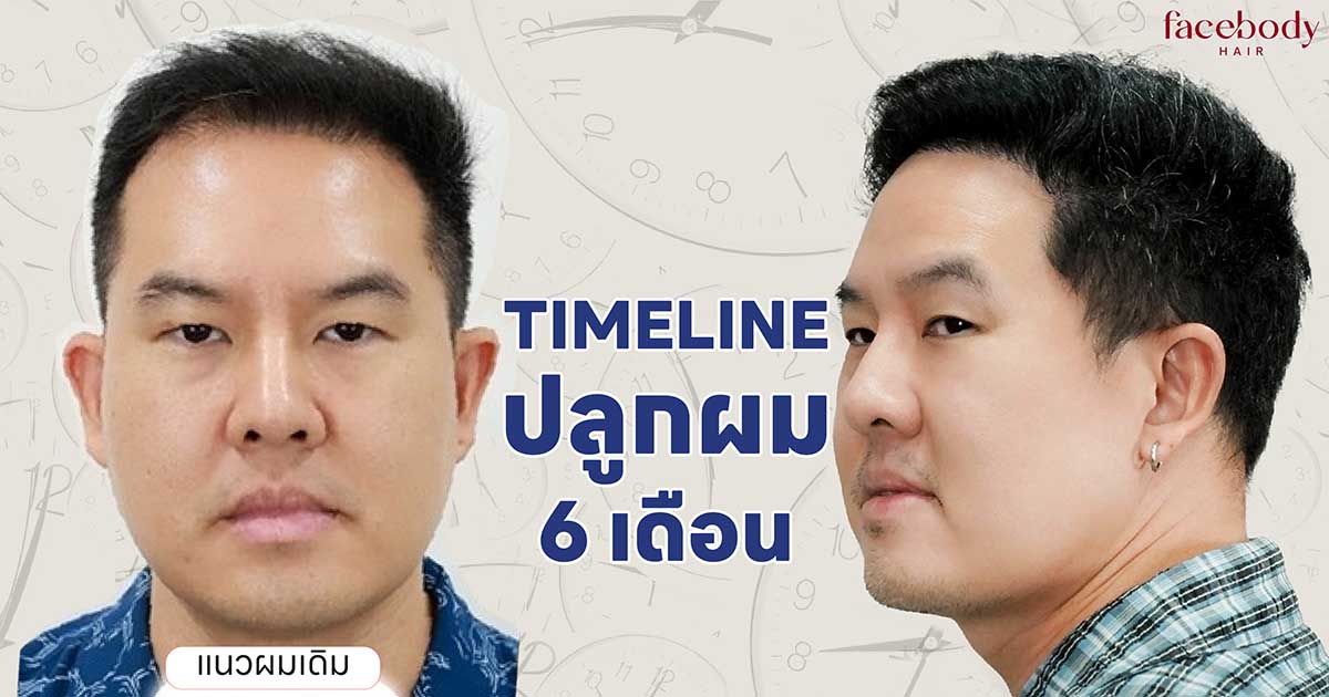 ไทม์ไลน์ปลูกผม 6 เดือน