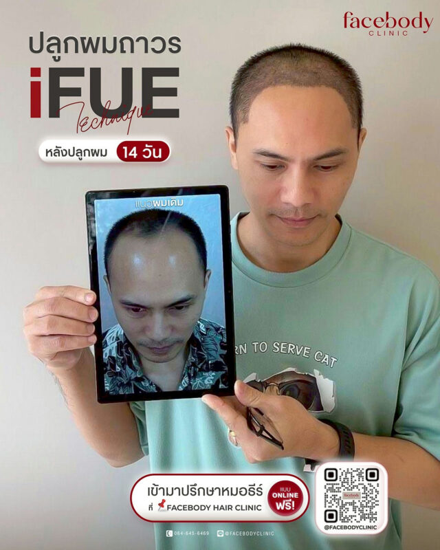ปลูกผมถาวร FUE : ทางออกสุดท้ายของคนผมบาง ที่คุณต้องรู้ก่อนตัดสินใจ