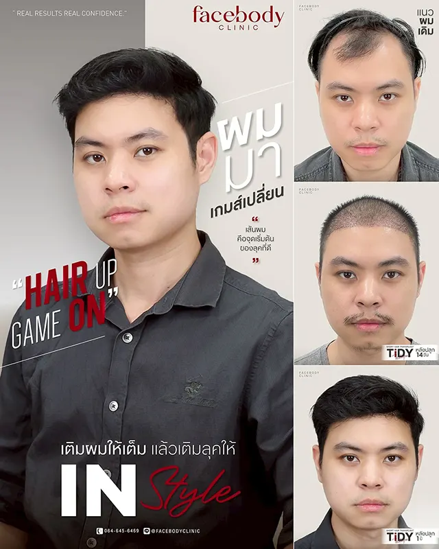 ปลูกผมราคา ปี 2025 2 Facebody Hair Banner