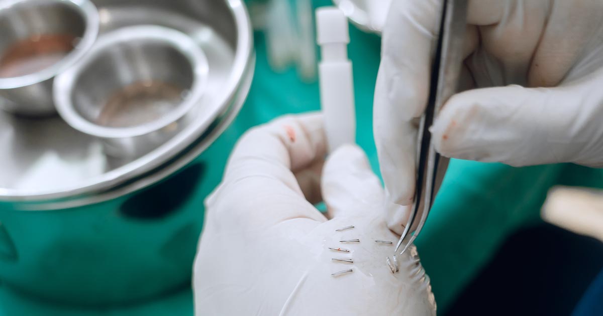 ปลูกผม 1000 3000 กราฟ