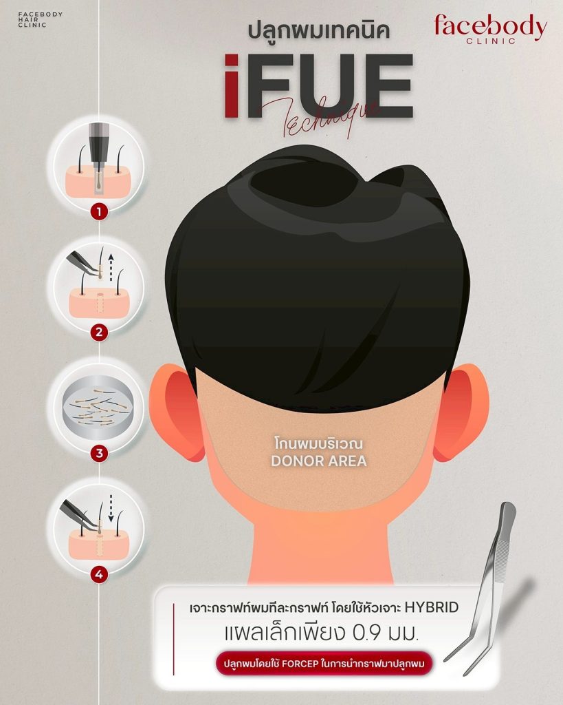 เทคนิคการปลูกผมแบบ iFUE เป็นศัลยกรรมปลูกผมด้วยการย้ายรากผมจากบริเวณท้ายทอยที่มีความแข็งแรงสูงและอัตราการหลุดร่วงน้อยที่สุด ด้วยการย้ายเซลล์รากผมทีละกราฟท์ผมด้วยอุปกรณ์พิเศษ มีแผลขนาดเล็กมาก ไม่ต้องมีแผลผ่าตัดยาว ไร้รอยเย็บแผล พักฟื้นไวกว่าเทคนิคแรก โดยทางเฟสบอดี้ คลินิก มีขั้นตอนและเทคนิคพิเศษเพื่อเพิ่มความหนาแน่นของผมที่ปลูก เพิ่มอัตราการอยู่รอดของเซลล์รากผม และแนวผมที่ขึ้นใหม่ดูเป็นธรรมชาติ