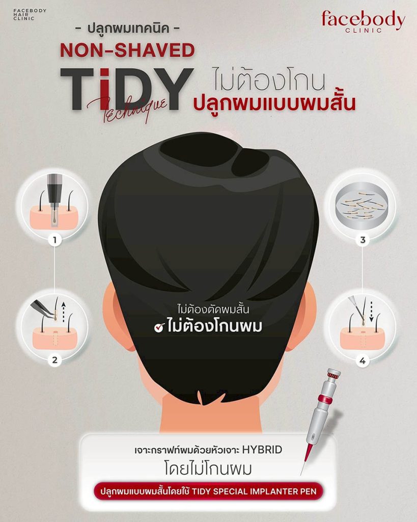 เทคนิคที่ดีกว่ากระบวนการปลูกผมเทคนิค TiDY โดยมีใช้เครื่องมือหัวเจาะขนาดเล็กออกแบบพิเศษที่จะช่วยเพิ่มความสมบูรณ์ของรากผมและลดระยะเวลาพักฟื้น และอุปกรณ์ใส่รากผมชนิดพิเศษ ที่สามารถควบคุมทิศทางแนวไรผมได้อย่างแม่นยำกว่า
