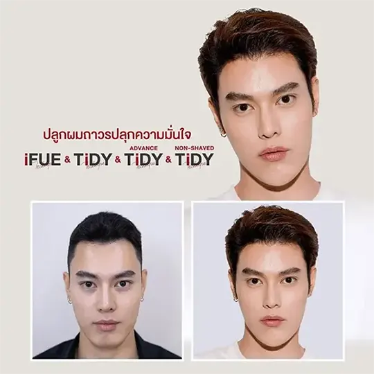 ปลูกผม ตัว Top 1 540