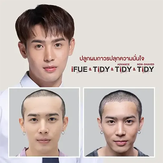 ปลูกผม ตัว Top 2 540