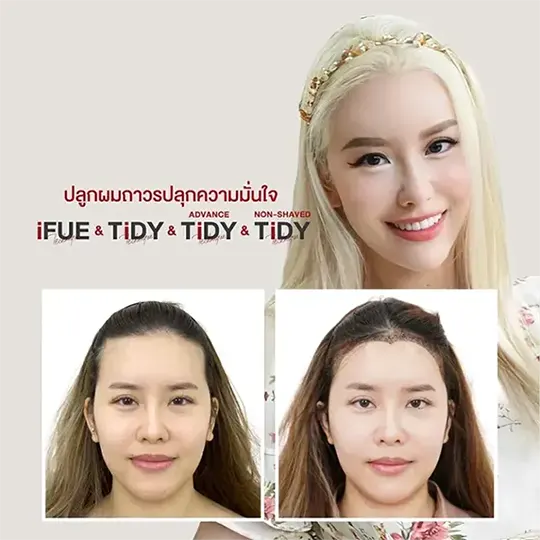 ปลูกผม ตัว Top 4 540