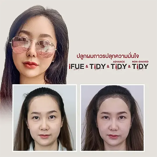 ปลูกผม ตัว Top 540
