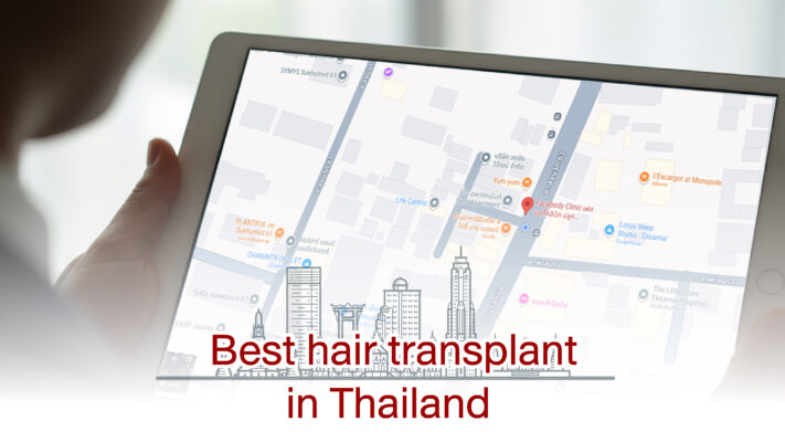 Best hair transplant in Thailand