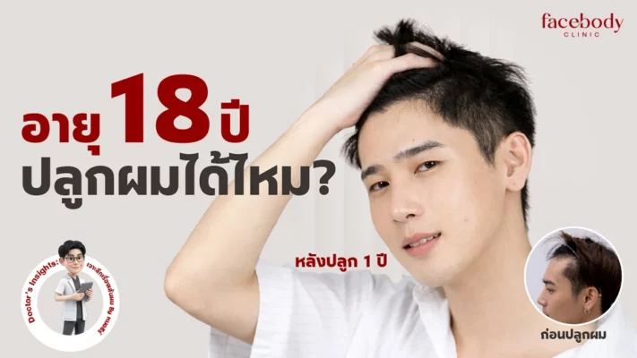 คุณหมอธีร์อธิบายอายุ 18 ปี ปลูกผมได้ไหม พร้อมเปรียบเทียบผลลัพธ์หลังปลูกผม 1 ปี Facebody Clinic