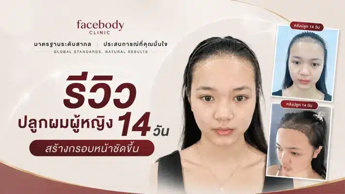 หลังปลูกผม ผู้หญิง 14 วัน Review-Female-hair-transplant-FUE