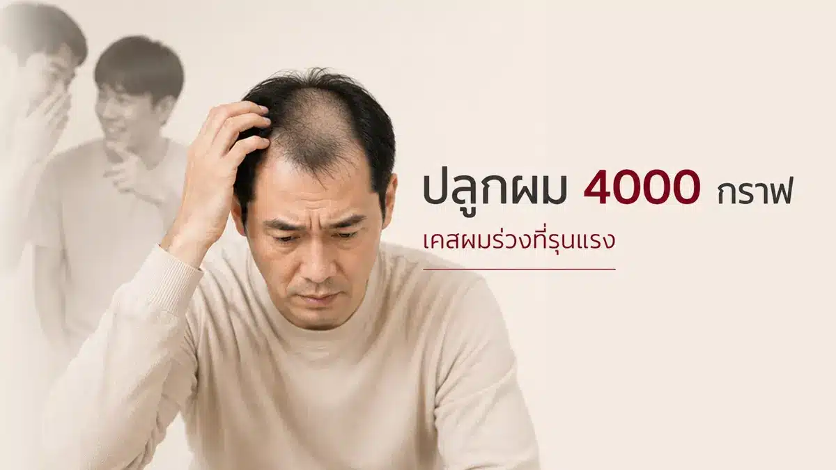 ปลูกผม 4000 กราฟ เคสที่มีพื้นที่เยอะ hair-transplant-4000-grafts-cost