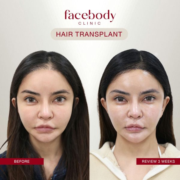 LINE_ALBUM_HAIR BA ผู้หญิง-(ปลูกผม คิ้ว)_241128_13